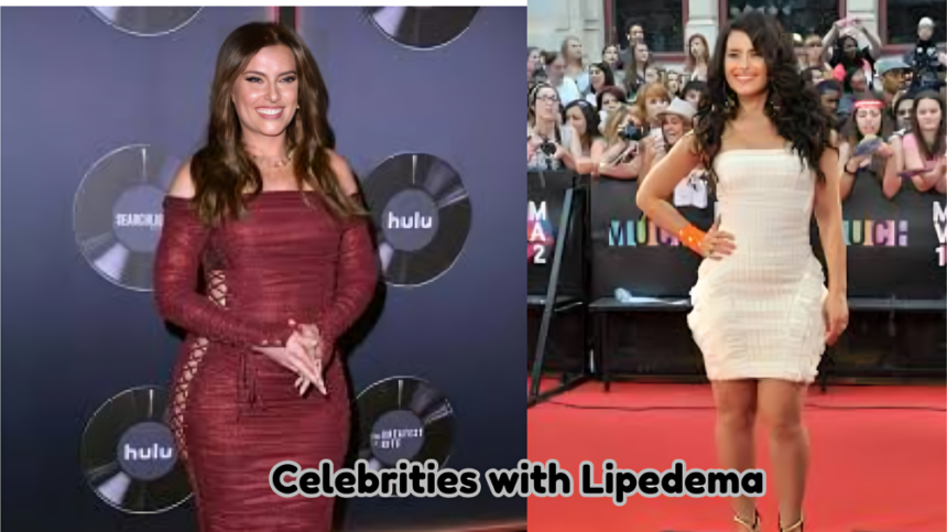 Celebrities with Lipedema